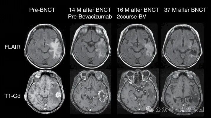 对抗“大脑杀手”脑胶质瘤有哪些黑科技？癌症疫苗、靶向、电场、CAR-T、质子等疗法各有突破