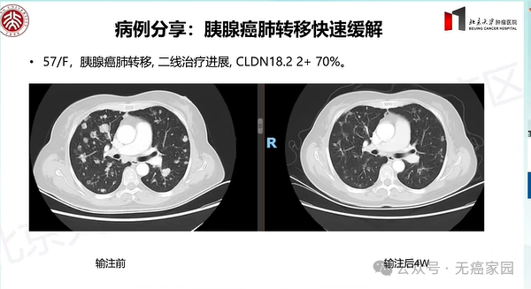 2026颠覆性突破！中国CAR-T疗法强势攻克胃癌、胰腺癌等实体瘤，治愈新希望来了！