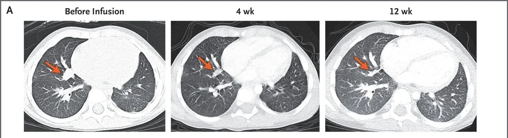 全球首例：2次输注肿瘤完全消失！新型CAR-T让晚期肝癌实现12个月无癌