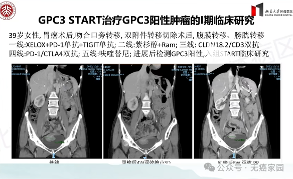 2026颠覆性突破！中国CAR-T疗法强势攻克胃癌、胰腺癌等实体瘤，治愈新希望来了！