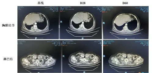 攻克“癌王”的万能钥匙，胰腺癌首款泛RAS靶向药获批，覆盖90%以上患者，六大前沿疗法联手宣战