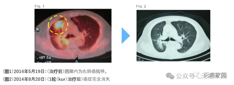 免疫治疗王炸组合！树突细胞疫苗激活，NK细胞清除，肝癌、胃癌、卵巢癌等病灶明显退缩！