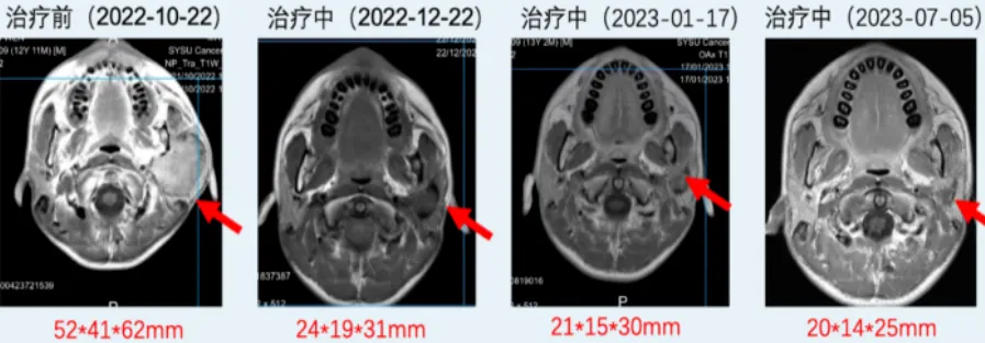 近90%患者肿瘤消退！革命性国研二代抗癌药上市！肺癌、肠癌、儿童肿瘤等全覆盖
