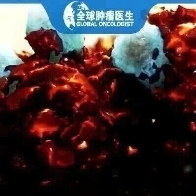 NK细胞七大重磅突破！胰腺癌/肝癌/淋巴瘤等多癌种，喜提“即取即用”新选择