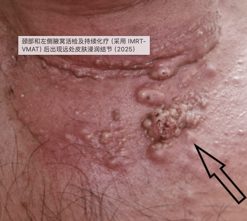 3个月肿瘤大幅消退！不限癌种靶向药改写全身扩散患者死亡结局！