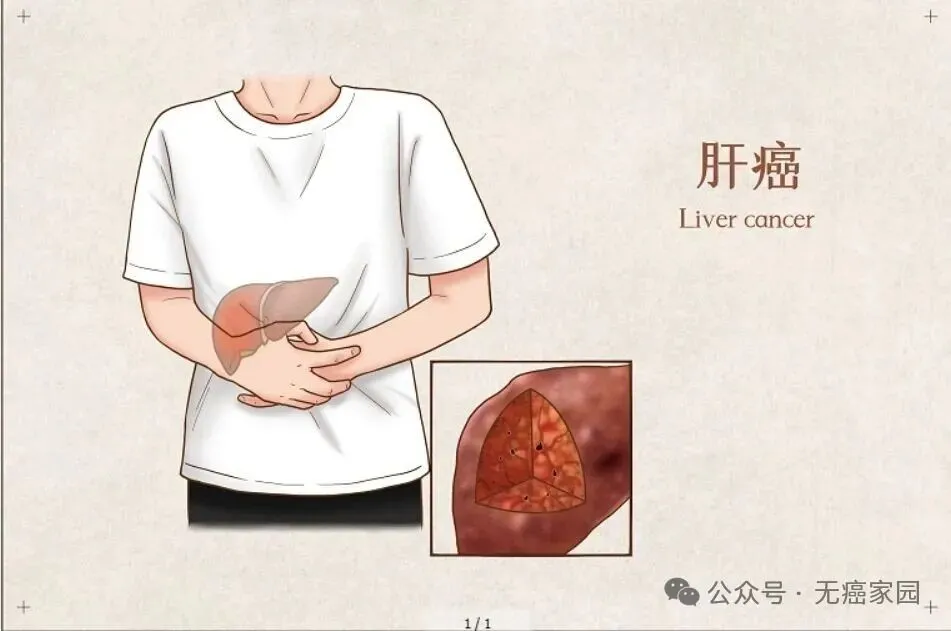100%疾病控制率，18周肿瘤清零：全球首款肝癌TIL疗法BST02临床数据重磅公布