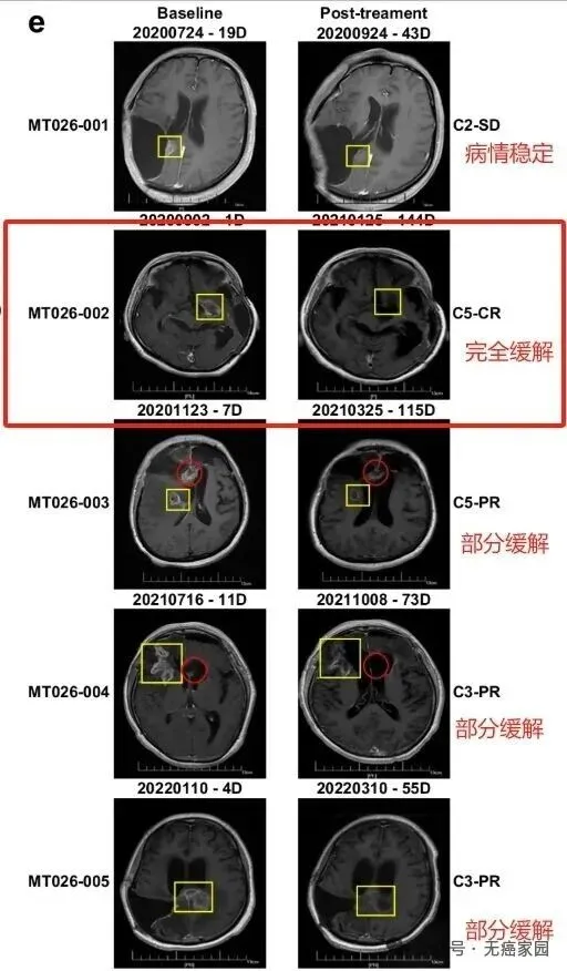 一针精准清除？脑胶质瘤CAR-T“双星”交出硬核答卷：80%缓解率，最长生存超33个月