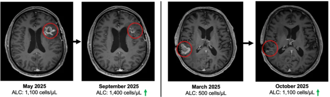 疾病控制率100%！疫苗、CAR-T、NK改写“死亡剧本”！2026脑瘤五大颠覆性疗法盘点