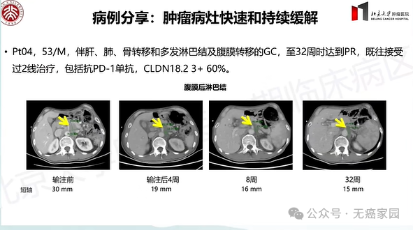 2026颠覆性突破！中国CAR-T疗法强势攻克胃癌、胰腺癌等实体瘤，治愈新希望来了！